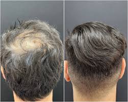 Vitamina B7 (Biotina) Pelo JOVEN